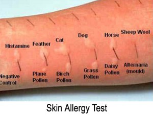 allergy-test