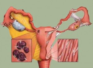 endometrioza-ili-cokoladna-cista-2