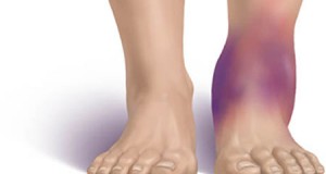 Отоците на нозете се знак за напредна болест – еве која