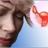 Симптоми на менопауза