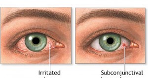 Крвави очи знак за висок притисок – спуштени капаци знак за мозочен удар