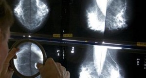 Мамографијата е бескорисна – покажало истражување на 90 000 жени