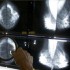 Мамографијата е бескорисна – покажало истражување на 90 000 жени