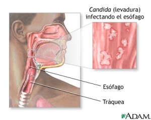 candida-infections-300x240