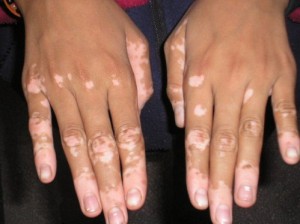 vitiligo-hands1