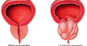 Симптоми на зголемена простата и лекување