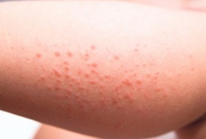 alergija-na-sunce-1376295436-351555