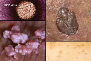 HPV kondilomi