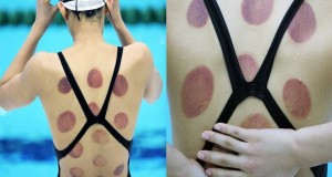 ВАНДУЗИ: Терапијата со чаши за болки во грбот која ја користат и олимписките спортисти