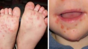 alergija sipanici dete