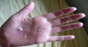 Ви се лупат дланките – еве што треба да направите