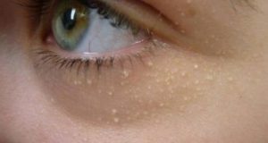 Бели точки под очите или капаците – ослободете се со неколку состојки
